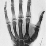 Almost immediately after the discovery of X-rays, doctors began using them to treat patients. This 1904 image shows an X-ray of a hand.