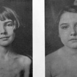 Before insulin, Type 1 diabetes was a death sentence. These photographs, taken four months apart, show how insulin treatments revolutionized treating diabetes.